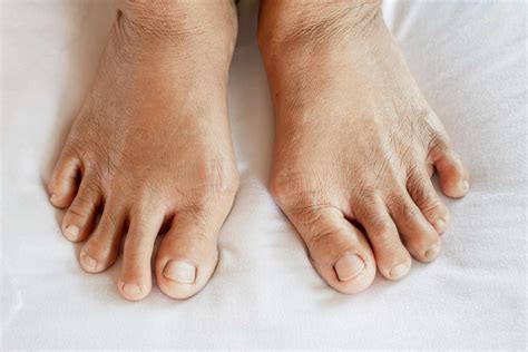 feetp|Early Signs of Arthritis in Feet .